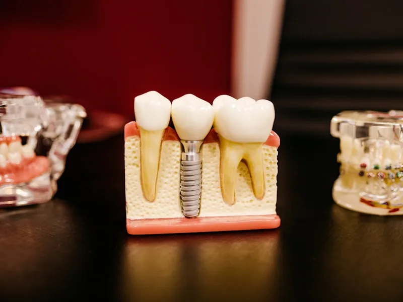 Dental Implants